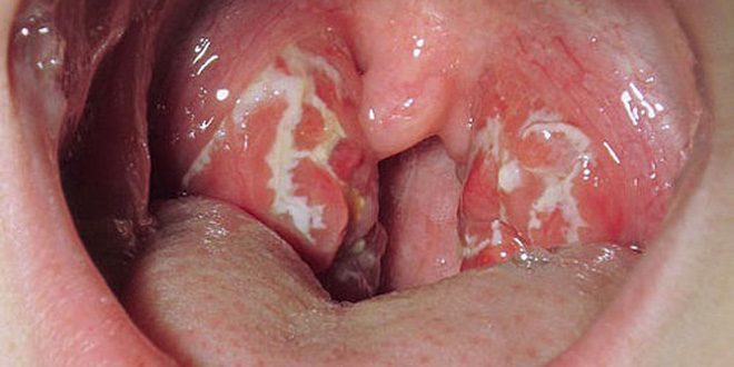 simptomi tonsilīts