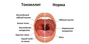 Hronisks tonsilīts: simptomi, komplikācijas, ārstēšana un daudz kas cits