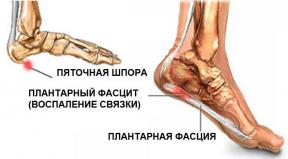 Plantāra fascīts: cēloņi un vingrinājumi, lai stiprinātu kāju