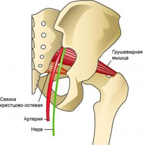 Kas ir piriformis sindroms un kā atbrīvoties no tā