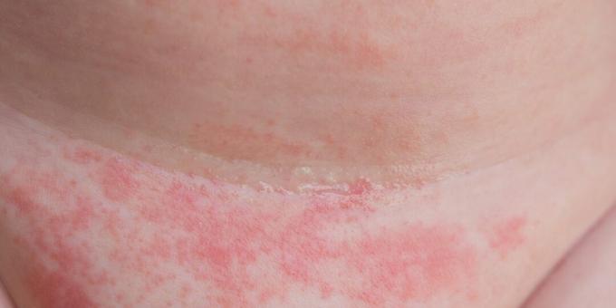 Dermatomikoze: ādas kandidoze