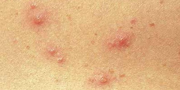 Simptomi vējbakām bērniem un pieaugušajiem: Diezgan bieži, āda uzreiz parādās mazi, sarkani punktiņi